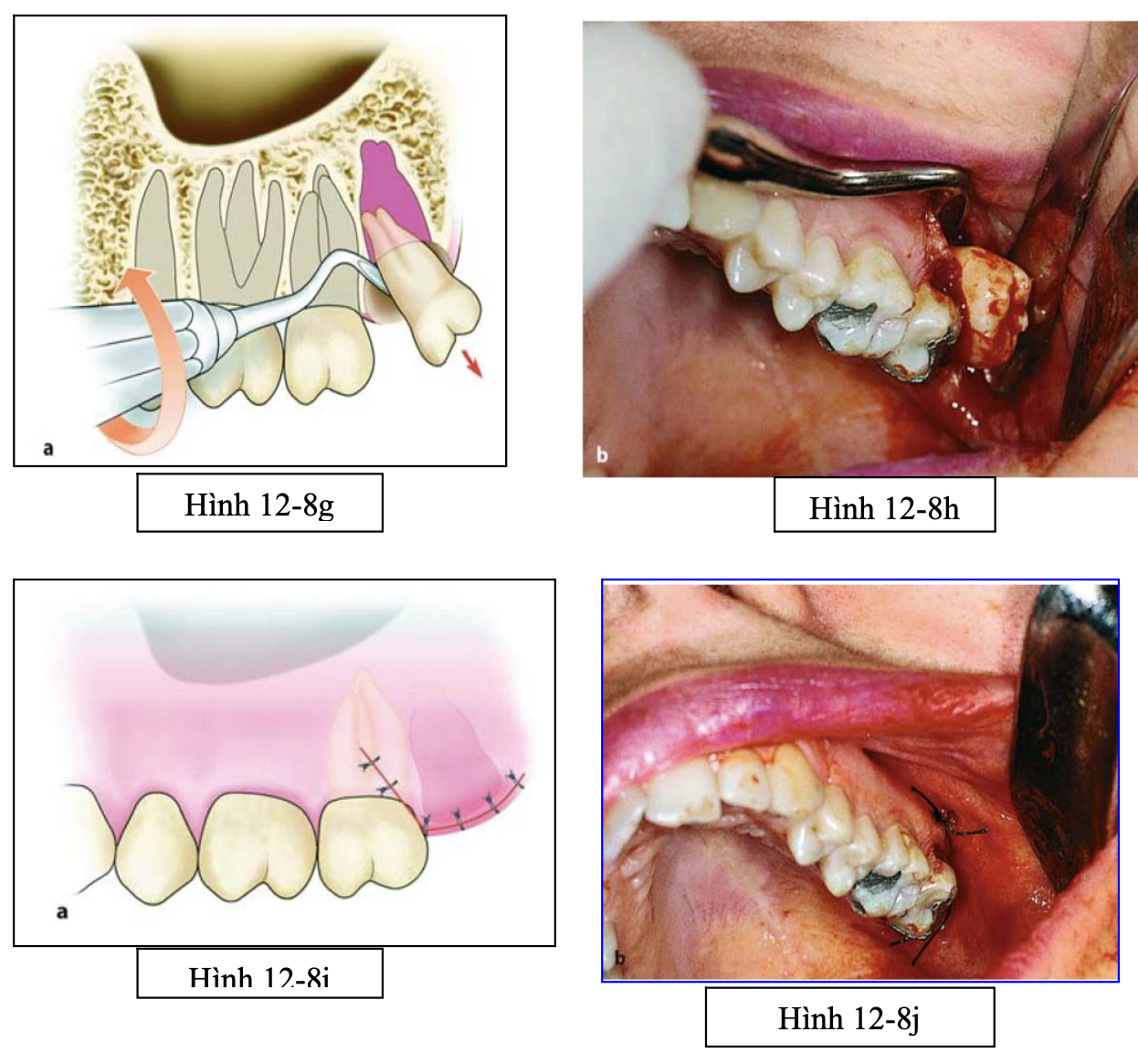 Tiểu phẫu răng khôn hàm trên
